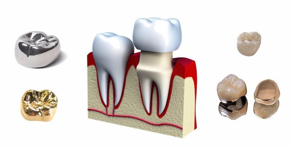 Different Types of Dental Crowns